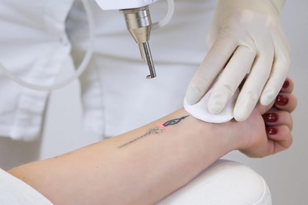 Laser-Tattoo-Removal-shutterstock_1234005517-scaled-1